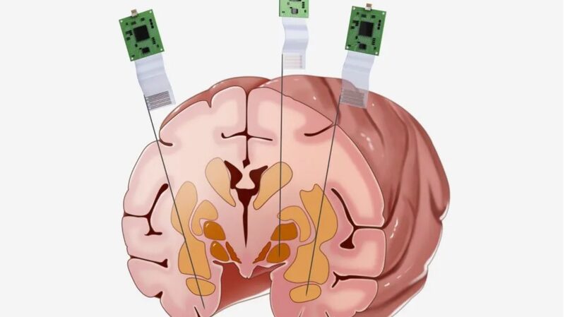 Revolutionizing_Neuroscience__China_s_First_1_024_Channel_Neural_Probe_Breaks_Ground - My Global News: Voices of a New Era Revolutionizing_Neuroscience__China_s_First_1_024_Channel_Neural_Probe_Breaks_Ground