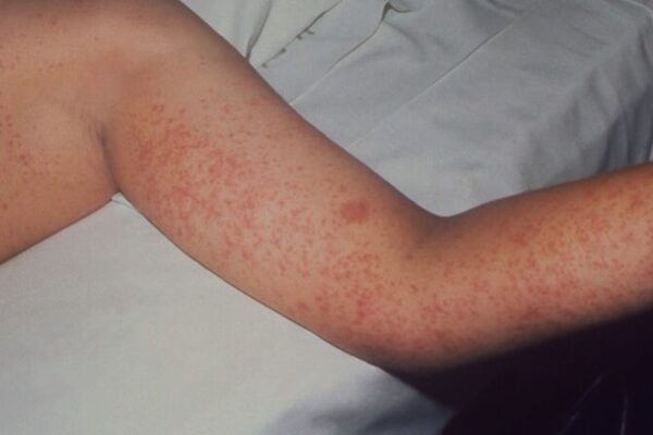 Measles_Outbreak_Escalates_in_Texas__Crosses_Into_Mexico video poster