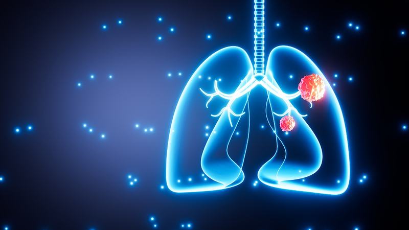 Air Pollution Tied to Lung Cancer Mutations in Nonsmokers Air_Pollution_Tied_to_Lung_Cancer_Mutations_in_Nonsmokers