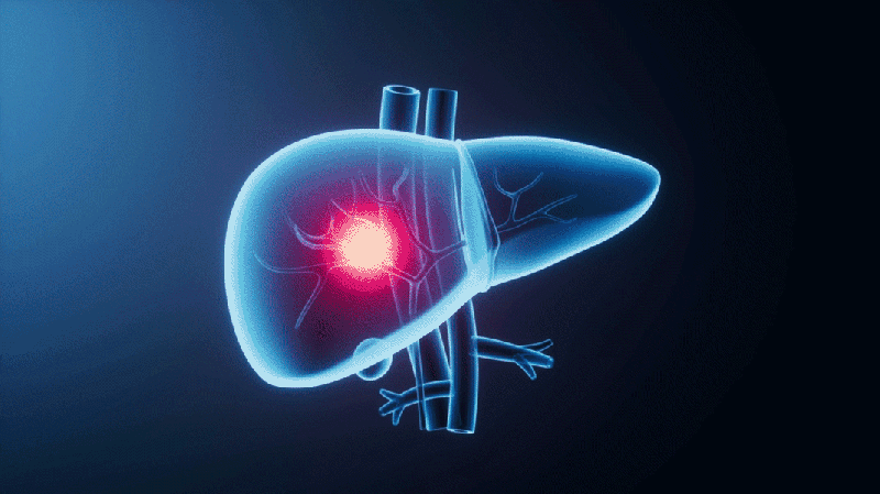 China-Led Lancet Report Charts Global Roadmap to Curb Liver Cancer China_Led_Lancet_Report_Charts_Global_Roadmap_to_Curb_Liver_Cancer