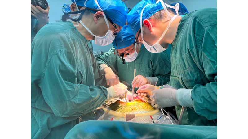 Historic_Xenotransplant__Gene_Edited_Pig_Liver_Sustains_Human_for_Nearly_Six_Months - My Global News: Voices of a New Era Historic_Xenotransplant__Gene_Edited_Pig_Liver_Sustains_Human_for_Nearly_Six_Months