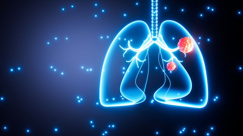 Up to 1 in 5 Lung Cancer Patients Are Nonsmokers, Study Reveals Up_to_1_in_5_Lung_Cancer_Patients_Are_Nonsmokers__Study_Reveals